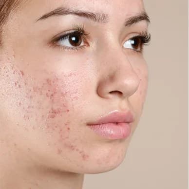 Active breakouts cleared, before