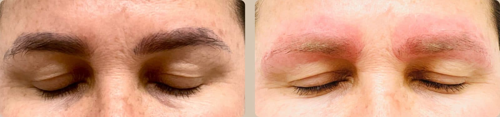 Before and after close up of a client's brows, the tattooed pigment much lighter in the after photo