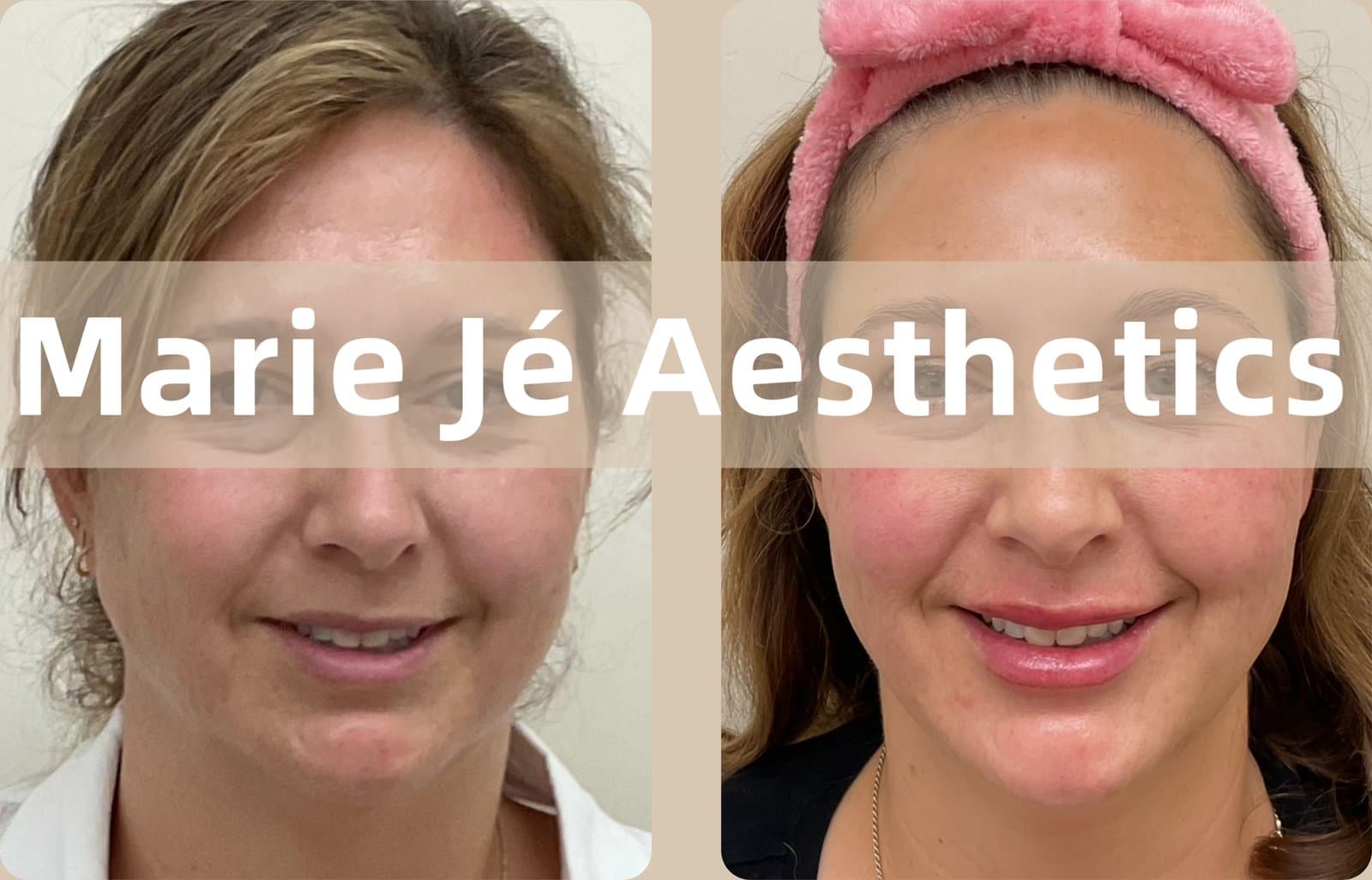 Side by side before and after of a smiling client, skin brighter and more lifted in the after photo
