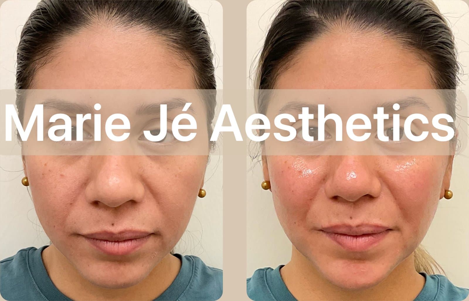 Side by side before and after of a client facing the camera, complexion more even in the after photo