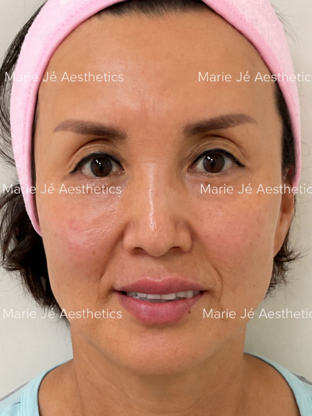 Smoother cheeks and a firmer jawline, after