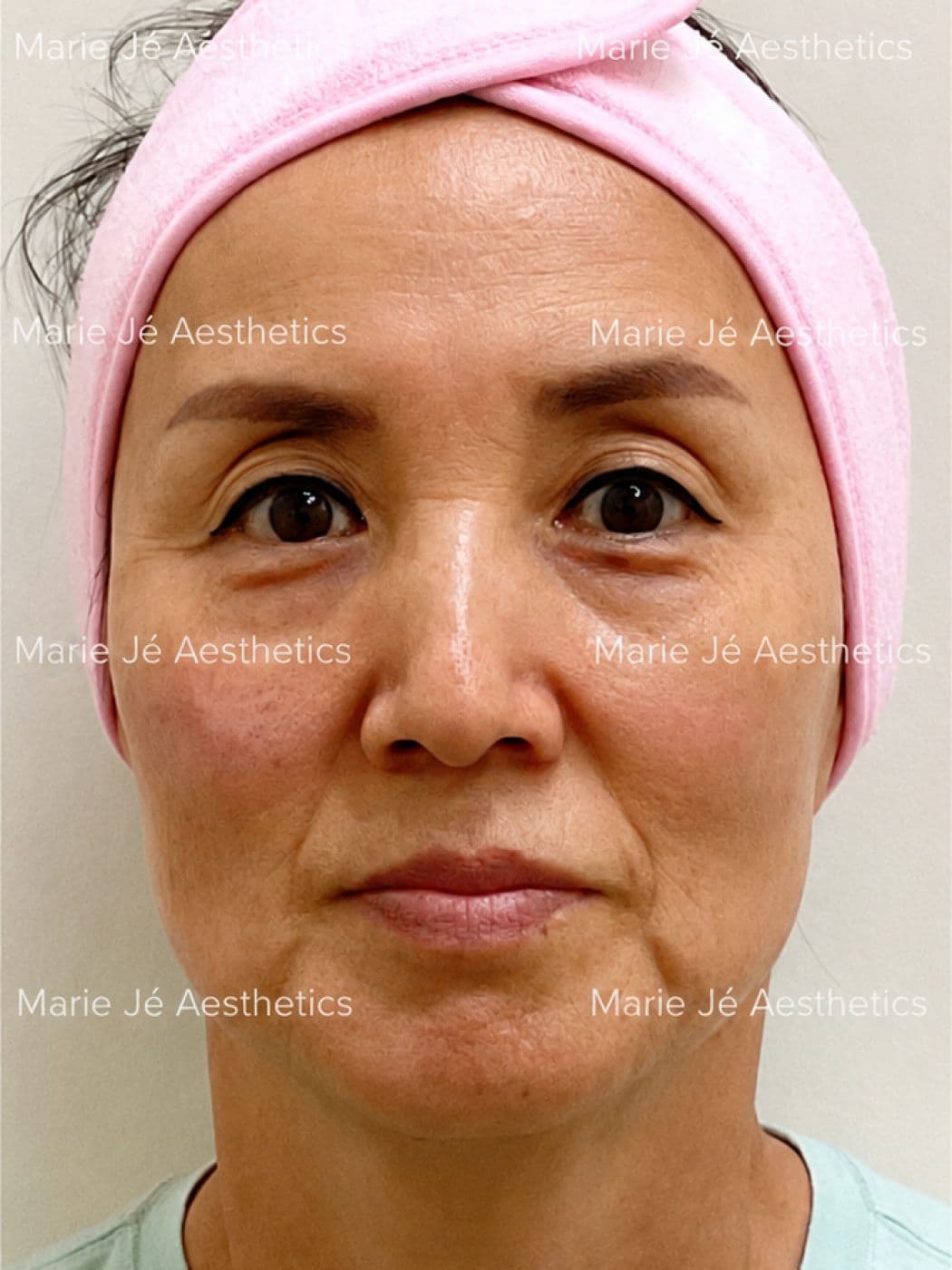 Smoother cheeks and a firmer jawline, before
