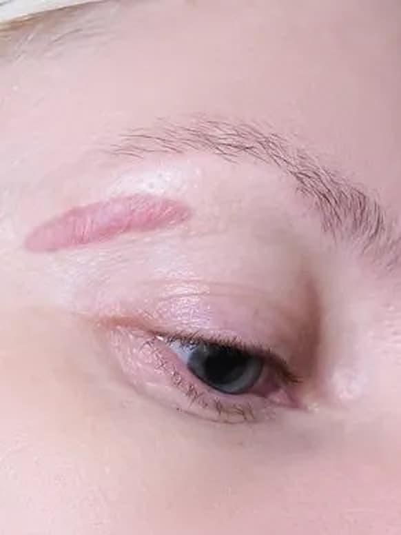 Acne Scars & Surgical Scars treatment at Marie Jé Aesthetics