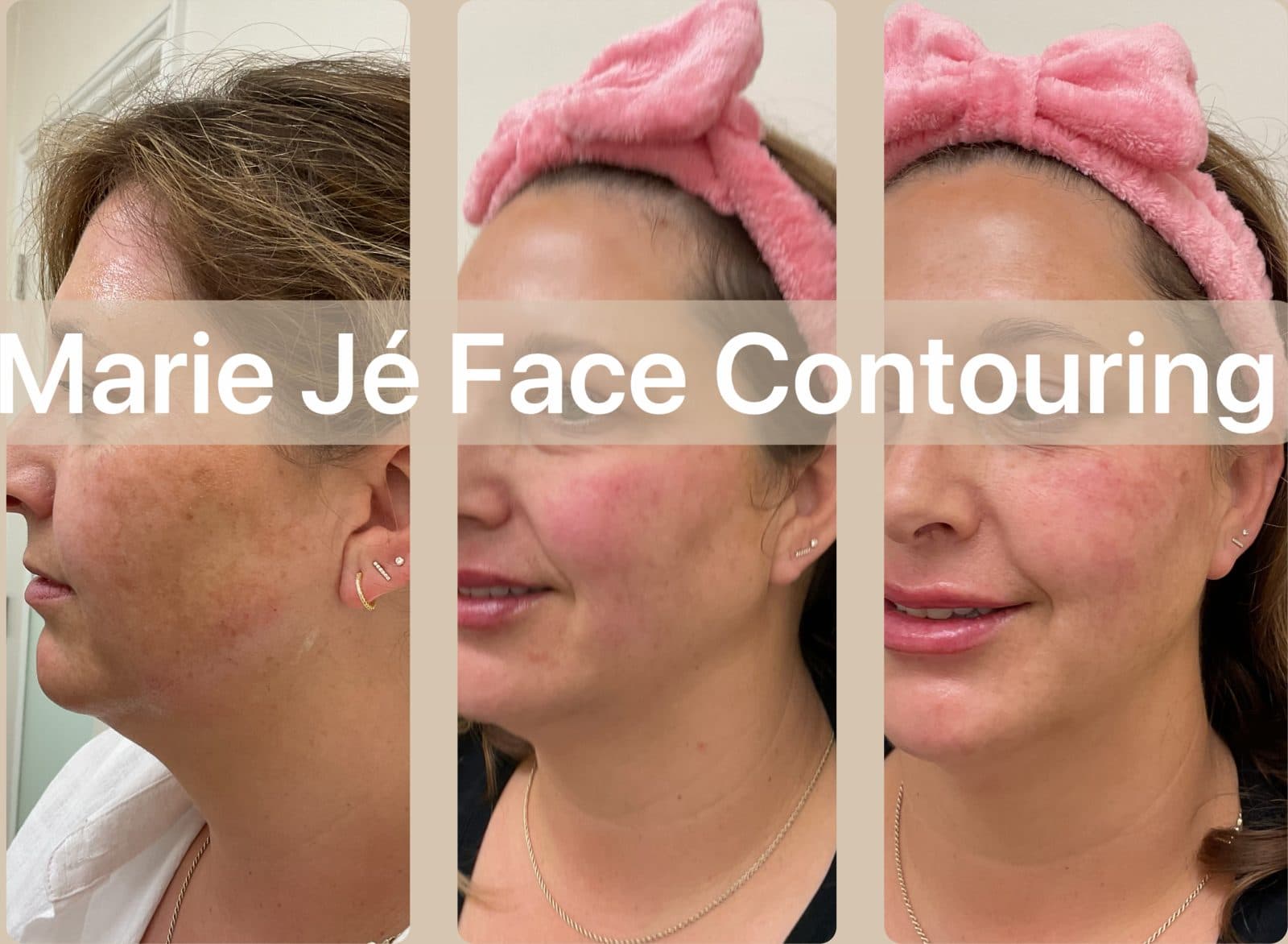 Three panel before and after of a client's jaw and neck, more defined in the later photos