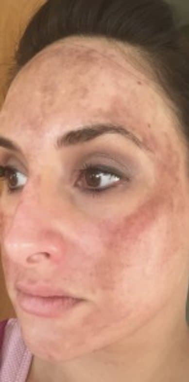 Pigmentation visibly faded, before