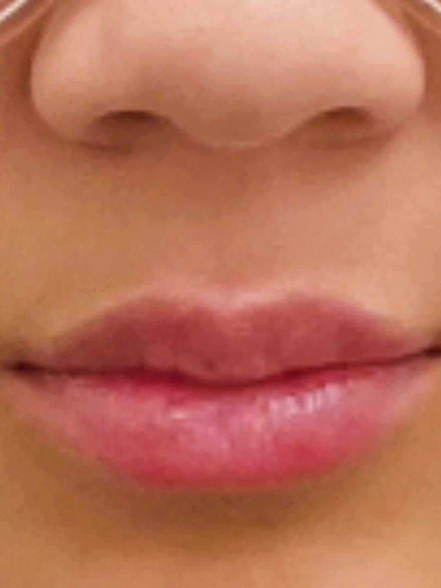 Fuller, defined lips at rest, after