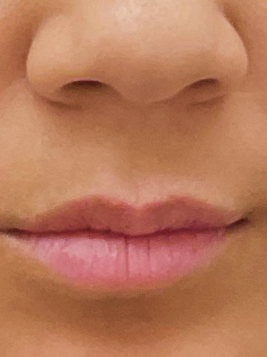 Fuller, defined lips at rest, before