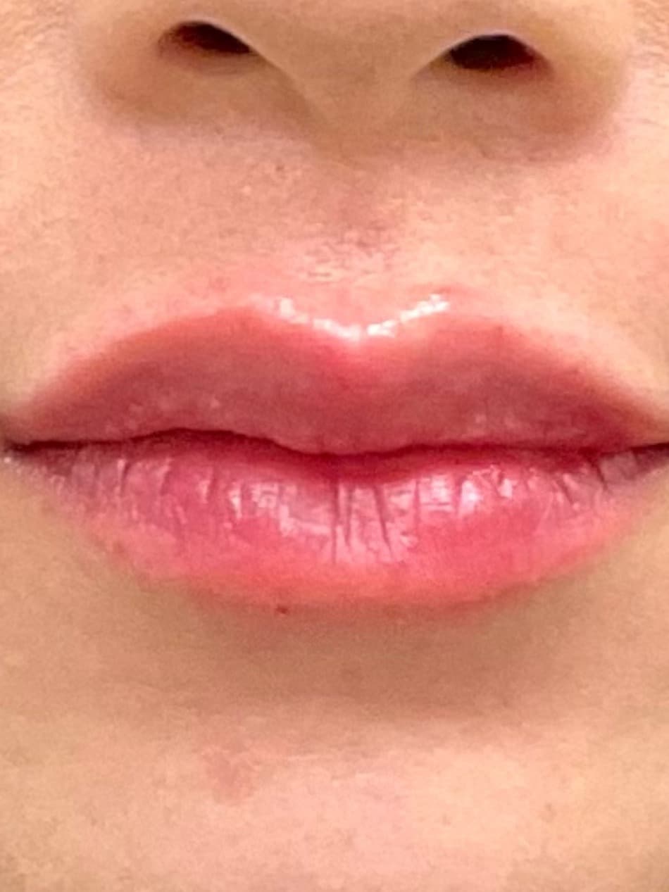 Thin or Undefined Lips treatment at Marie Jé Aesthetics