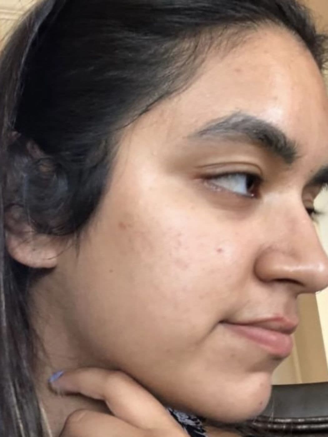 Laser Scar Treatment at Marie Jé Aesthetics