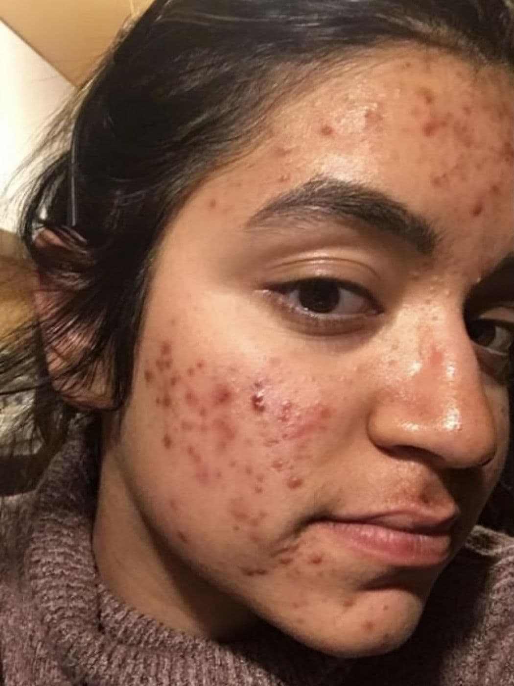 Acne scarring and active breakouts cleared, before