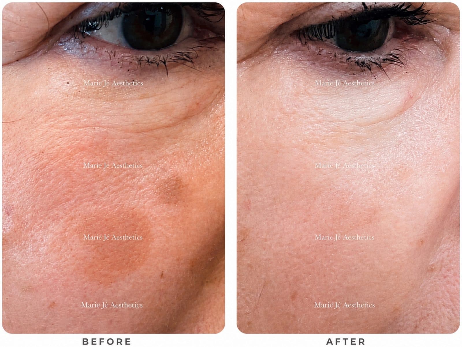 Before and after close up of a client's under eye area, a brown patch faded in the after photo