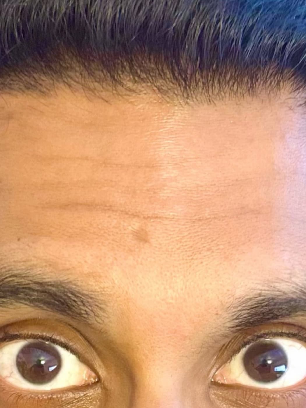 Forehead lines, raised brows and all, after