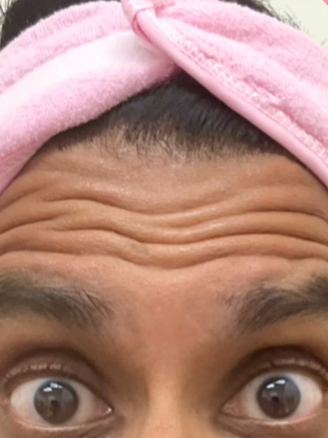 Forehead lines, raised brows and all, before