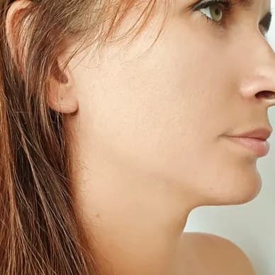 XERF Lifting at Marie Jé Aesthetics