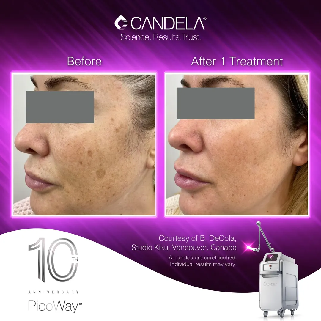Candela PicoWay before and after one treatment, showing visibly reduced facial pigmentation